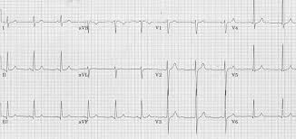 Image result for Q Wave