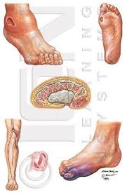 Diabetic Foot Care It Is Possible For Foot Ulcers To Develop In Relation To Diabetes Feet Care Diabeties Diabetes Information