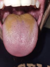 Image result for yellow tongue infection