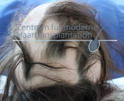 Haarausfall Frauen Haufigste Ursachen Behandlung Expertentipps