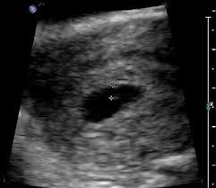 normal 1st trimester ultrasound how to