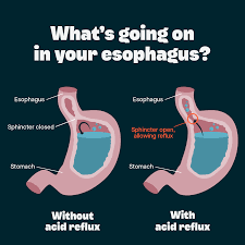 Gerd is caused by frequent acid reflux. What Causes Acid Reflux Evens