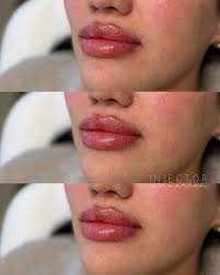 𝑪𝒉𝒊𝒏 & 𝑳𝒊𝒑 𝒇𝒊𝒍𝒍𝒆𝒓 𝑪𝒐𝒎𝒃𝒐 🔥 Mayra Gamboa BSN , RN ✨ To  book click the link in my bio ✨ @chamataplasticsurgery #woodlandsinjector  #houstoninjector #nurseinjector #myevergreenmedspa #restylane #allergan  #houstonmedspa #dermalfiller ...