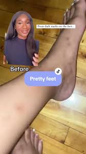 Image result for brown patches on the feet