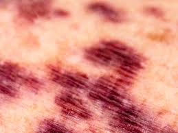 They differ from normal bruises in several ways. Deep Purple Spots On Skin