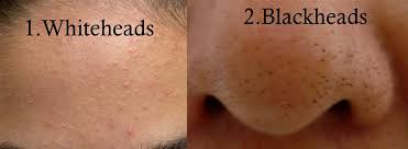 See more of cara mudah hilangkan jerawat, jeragat, blackhead, whitehead dan kulit kusam on facebook. 9 Tips Mudah Hilangkan Blackhead Whitehead Pada Muka