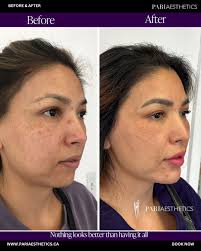 This incredible transformation is due to regular, filler and regular  chemical and technical skin treatments over time.⁠ ⁠ Natural results are  the only results we provide.⁠ ⁠