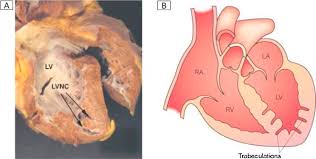 Image result for Left Ventricular Noncompaction