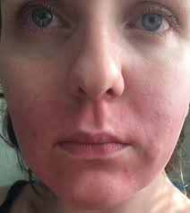 Nair nair hair removal cream has been clinically & dermatologically tested and is gentle enough to use on legs, bikini and underarms. Boots Customer Left With Chemical Burn Like Red Marks On Her Face After Using Store S Own Hair Removal Cream Mirror Online