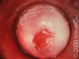 Image result for gonorrhea symptoms