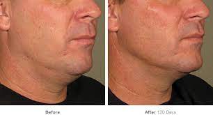 Fda Approved Treatment For Turkey Neck Chevy Chase Md