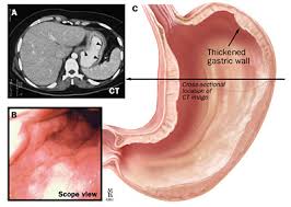 Total gastrectomy is used most often for stomach cancers that affect the body of the stomach and those that are located in the gastroesophageal junction. Gastric Carcinoma A Review On Epidemiology Current Surgical And Chemotherapeutic Options Intechopen