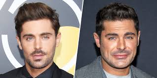 Zac Efron Jaw Accident: How Has His Face Changed?