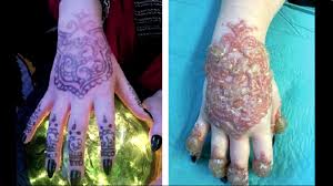 When it's likely to appear: Henna Dermatitis Allergic Contact Dermatitis Youtube