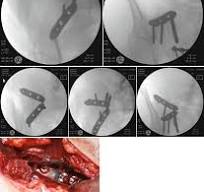 Anterior Plating of the SI Joint | Springer Nature Link
