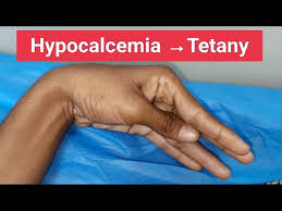 Image result for Tetany