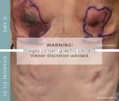 Image result for Mastectomy