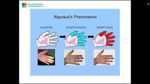 What Causes Raynaud S Sruk
