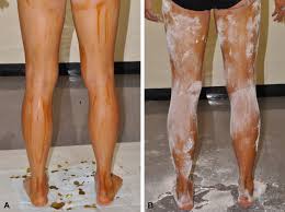 Image result for Anhidrosis