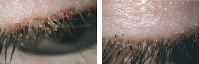 Image result for pubic lice symptoms
