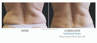 Cool sculpting before and after pictures demonstrate why so many people are raving about this fat freezing procedure. Toronto Coolsculpting Coolsculpting Cost Coolsculpting Before After Pictures Laser Treatments Signature Medispa