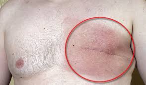 For more information, see the national cancer institute's male breast. All You Need To Know About Male Breast Cancer The Samikhsya