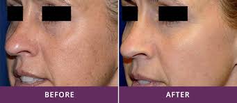 The revlite laser treatment at coco skin laser health is an effective procedure for blackheads, enlarged pores, fine lines, melasma, mild acne, pigmentation, radiation tattoos. Revlite Si Gold Standard Of Laser Machines