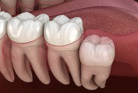 Impacted upper and lower wisdom tooth pushing adjacent teeth. Is Wisdom Tooth Removal Painful