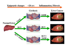 Most people don't have signs and symptoms in the early stages of primary liver cancer. Epigenetic Etiology Of Human Liver Disease And The Impact Of Alcohol And Hepatitis Viral Infection On The Epigenome Epigenetic Etiology Of Human Disease Keith D Robertson Mayo Clinic Research