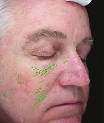 A Correlation of the Glogau Scale With VISIA-CR Complexion Analysis  Measurements in Assessing Facial Photoaging for Clinical Res