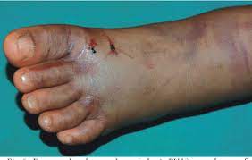 This can progress to swelling and bruising at the wound and all the way up the arm or leg. Snakebite Envenoming Fact Sheet Africa Health Organisation