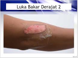 Image result for Combustio