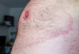 We did not find results for: Lymska Borelioza Prejavy Diagnostika Liecba Nasledky Zdravovek