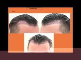 Propecia Und Minoxidil Kombination Viagra Der Abschluss Steht