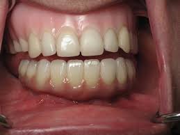 My teeth — sometimes called marine calcifiers or coral reefs — have been suspiciously sore for days. Should I Pull All Of My Teeth And Get Dental Implants Ramsey Amin Dds