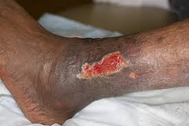 Image result for Stasis Dermatitis