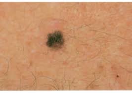 In stages three and four, the melanoma has spread beyond the skin and into the lymph nodes and/or distant organs, like the liver, lungs, brain, bone or soft tissues. Melanoma Warning Signs And Images The Skin Cancer Foundation