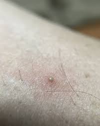After scraping my chin on the ground and then having a bump of what i thought was just scar tissue i found out that i had had hair growing underneath my skin. Ingrown Hair Removal How To Get Rid Of Ingrown Hairs Expert Recommends Treatment Express Co Uk