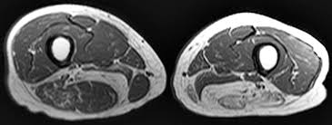 Whether it's to pass that big test, qualify for that big promotion or even master that cooking technique; Mri Patterns Of Neuromuscular Disease Involvement Thigh Other Muscles 2