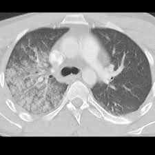 Image result for Pulmonary Contusion