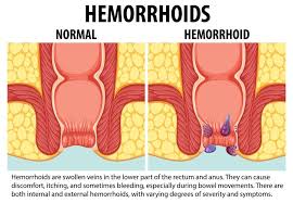 Image result for Hemorrhoid