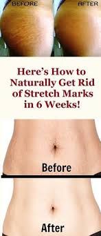 Here S How To Naturally Get Rid Of Stretch Marks In 6 Weeks Stretch Marks Stretch Mark Remedies Skin Care
