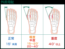 外反母趾の原因を徹底リサーチ
