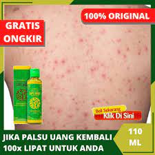 Rasa gatal bisa terasa di bagian tubuh tertentu atau bahkan di seluruh tubuh. Obat Gatal Gatal Di Seluruh Badan Alergi Infeksi Jamur Obat Gangguan Kulit Gatal Di Paha Kaki Tangan Dan Tubuh Obat Herbal Bintik Bintik Merah Cocok Untuk Anak Dan Dewasa Ibu Hamil Dengan Oles Balur Salep