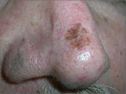 How do you inherit skin cancer? Growing Spot On Nose Mdedge Family Medicine