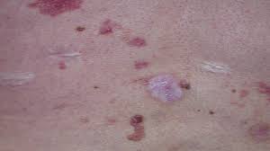 Heat rash , sometimes called prickly heat, is common on the underside of the breast. Skin Cancer Rash Itchiness And Symptoms