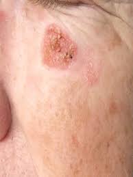 When wondering what skin cancer looks like on your face it is important to know that melanoma can occur in a variety of colors including brown, black, red, blue … Disease Management Nonmelanoma Skin Cancer
