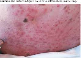 Human herpes virus types hhv. Widespread Herpes Simplex Virus Type 1 Infection On The Back Of A 79 Year Old Male Patient With Respiratory Failure And Icu Admission Semantic Scholar