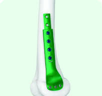 3.5mm Pediatric Femoral Sliding Locking Plate - xpmed