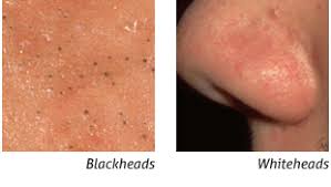 Although it's normal to have this type of bacteria on your skin, it can turn into an infection when it gets trapped in your pores alongside sebum. Absorica Severe Recalcitrant Nodular Acne Nodular Acne Acne Esthetics